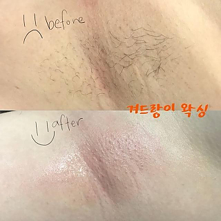 겨드랑이 왁싱 thumbnail image