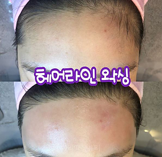 헤어라인왁싱 thumbnail image