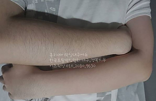 팔 왁싱 전후 thumbnail image