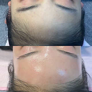 이마 헤어라인 왁싱 thumbnail image