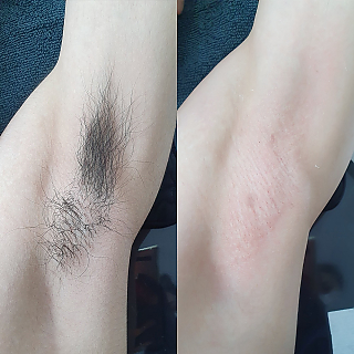 겨드랑이왁싱 thumbnail image