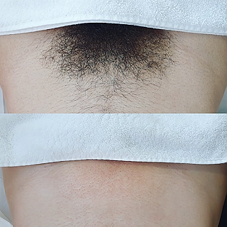 브라질리언왁싱 thumbnail image