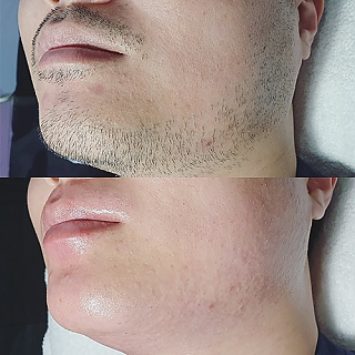 수염왁싱 thumbnail image